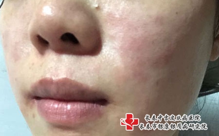 长春治疗皮炎大概需要多少费用