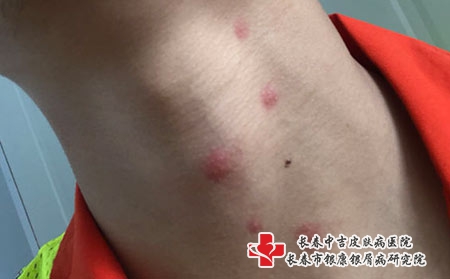 长春治疗皮炎的价格是多少，长春治疗皮炎专科哪家好