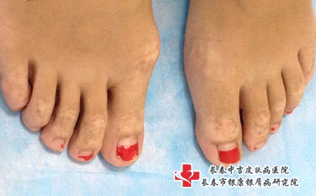 如何治疗青少年的白癜风，长春白癜风哪家治疗好
