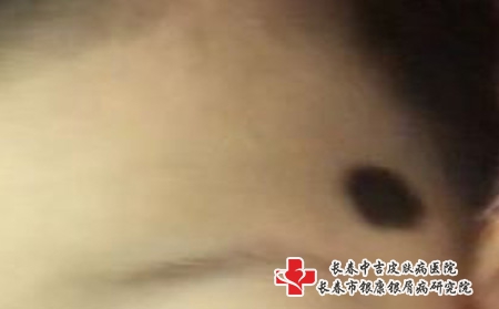 长春哪家医院去除红色胎记比较好