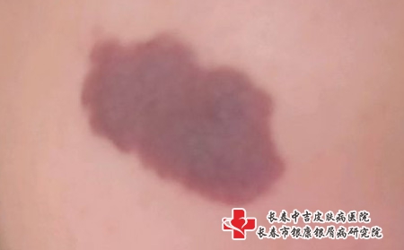 长春胎记医院治疗新生儿红色胎记哪家好