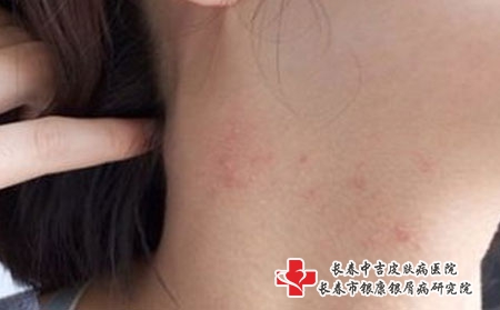 女性患上痤疮的原因哪些，长春治疗痤疮专科哪家好