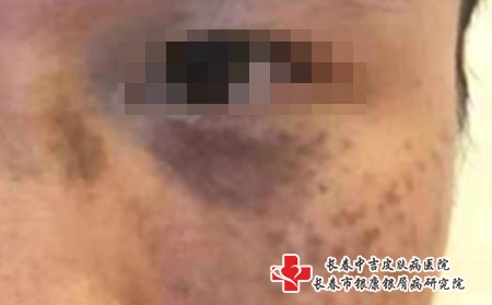 黑胎记治疗费用和什么有关，长春治疗胎记多少钱