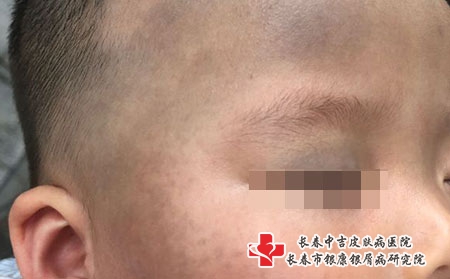 治疗黑胎记的方法，长春治胎记医院好