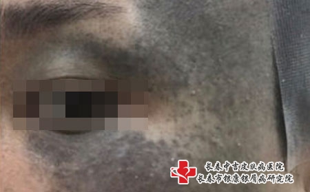 黑色胎记的去除方法有哪些， 长春医院治疗黑胎记哪家好