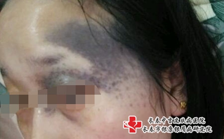 黑胎记具体是怎样形成的，吉林祛黑胎记哪个医院好