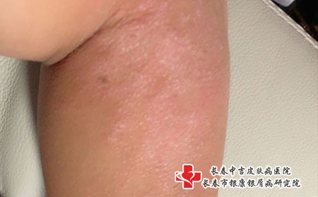 引起皮炎的原因有哪些，长春皮炎哪家医院看的好