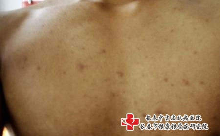 长春哪个医院治疗痤疮好，长春治疗痤疮专科哪家好
