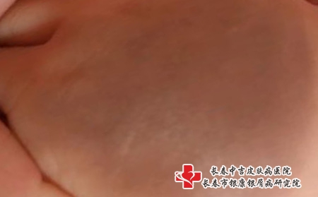 青胎记怎么去除，长春治疗孩子青胎记的医院排名