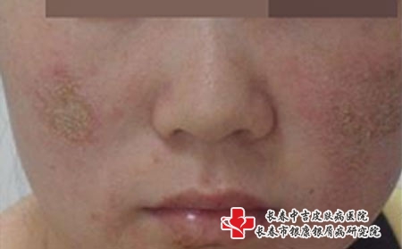 长春治疗皮炎哪里的医院比较好，长春治疗皮炎医院排行