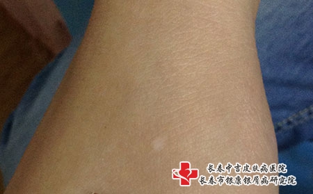 日常生活中该如何预防白癜风，长春专治白癜风的医院