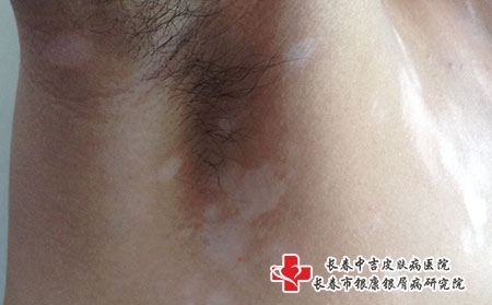 长春哪家医院治疗白癜风好，长春治疗白癜风专科