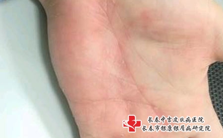 看皮肤过敏长春哪家医院好，长春治疗过敏专科