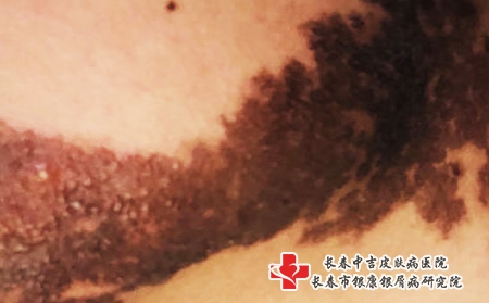 长春黑色胎记去除费用是多少，长春胎记鳌头中吉