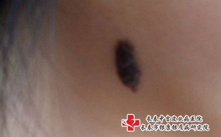 黑色胎记能去掉吗，在长春市看黑色胎记哪里比较好
