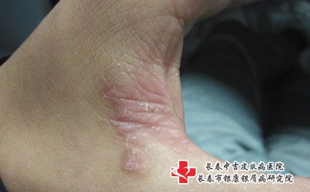 生活中湿疹患者应该注意哪些禁忌，长春湿疹哪家治疗好