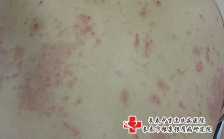 长春专业治疗白癜风的医院，长春白癜风哪家医院看的好