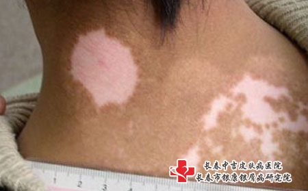为什么白癜风越早治疗越好，长春治疗白癜风要花多少钱
