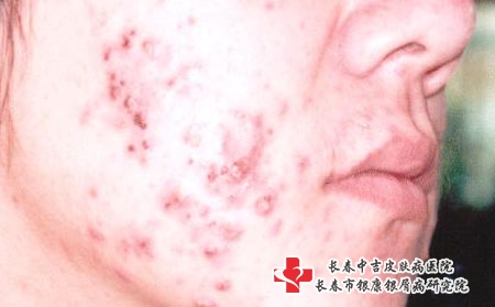青春痘在脸上留下坑印怎么办，长春治疗痤疮专业医院