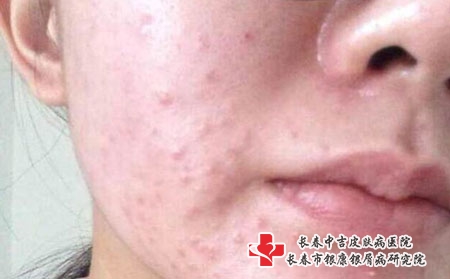 脸上青春痘严重怎么办,长春治疗痤疮专科 脸上青春痘严重怎么办,长春治疗痤疮专科