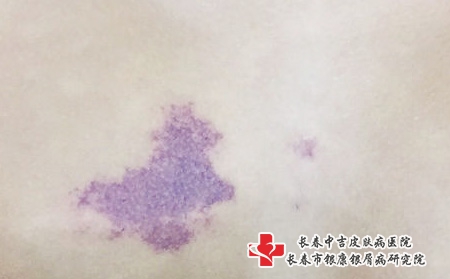 红色胎记能去掉吗，激光宝宝胎记长春哪家的好