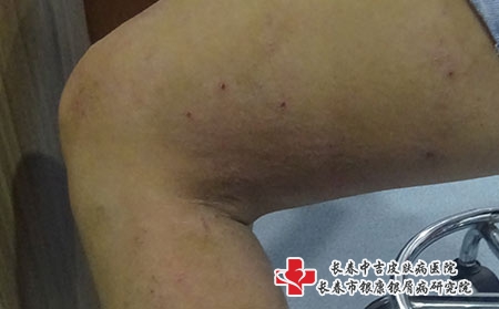 长春中吉皮肤病医院浅谈湿疹的护理,长春治疗湿疹专业医院 长春中吉皮肤病医院浅谈湿疹的护理,长春治疗湿疹专业医院