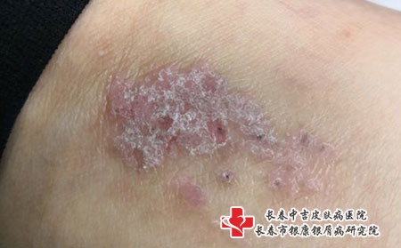 长春中吉皮肤病医院讲解皮炎的症状，长春治疗皮炎要花多少钱