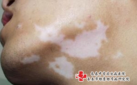 怎样才能防止腿部白癜风扩散，长春治疗白癜风专科