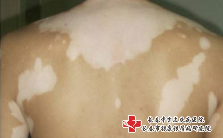 怎么做能防止白癜风在脸上复发，长春白癜风哪家医院看的好