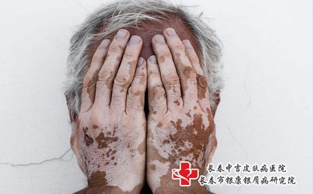 脖子上有早期白癜风应该多吃些什么，长春白斑必来中吉