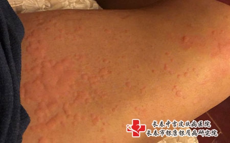 长春检查过敏源的费用要多少，长春过敏哪家医院看的好