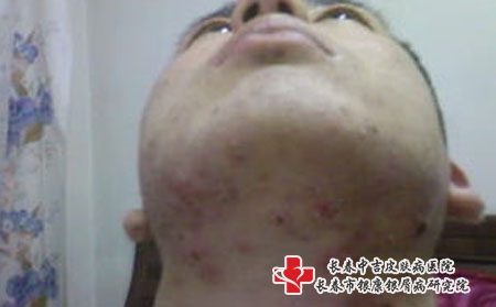 长春中吉讲解痤疮的病因,长春治疗痤疮權威的医院 长春中吉讲解痤疮的病因,长春治疗痤疮權威的医院