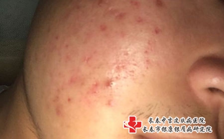 长春专治痤疮的医院，长春治疗痤疮医院有哪些
