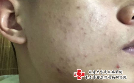 长春痤疮哪家医院看的好，长春治青春痘哪里好