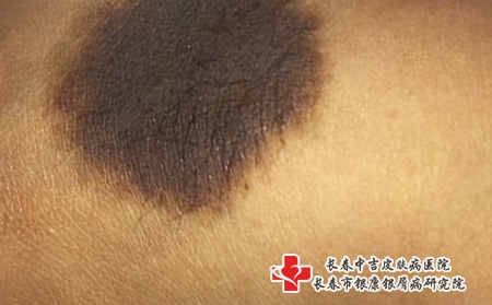 黑色胎记能去掉吗，在长春市看胎记中吉好