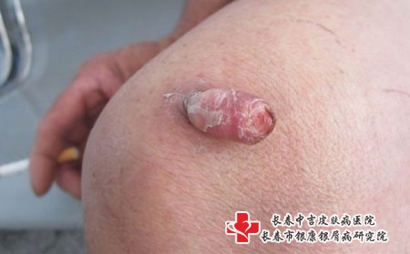扁平疣的诱因有哪些，长春去中吉看皮肤病好