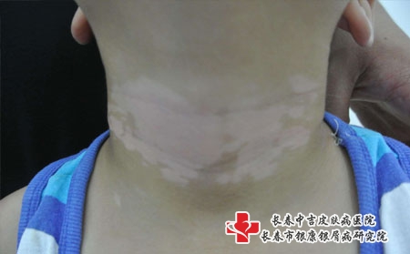 白癜风对人们有哪些影响，得了白癜风去长春中吉