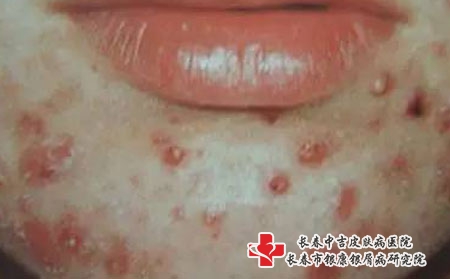 女生为什么喜欢长痘痘呢，长春治疗痤疮要花多少钱