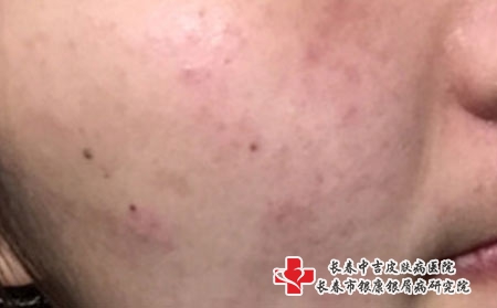 长痘痘了怎么调理，长春治疗痤疮专业医院