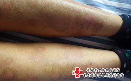 银屑病在日常中去注意什么问题，长春中吉银屑病医院好吗