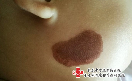 红色胎记会遗传吗,长春胎记医院治疗红色胎记靠谱吗 红色胎记会遗传吗,长春胎记医院治疗红色胎记靠谱吗