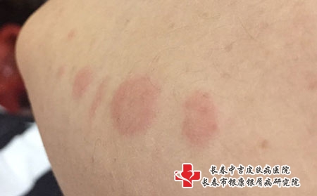 治疗皮炎的方法是什么，长春治皮炎好点的医院