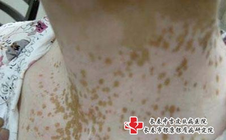 白癜风病情加重的原因有哪些 ，长春治疗白癜风哪个医院好