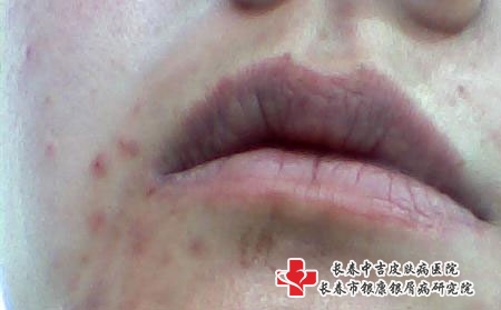 痘痘患者应该注意什么样的调理,长春治痘痘比较好的医院 痘痘患者应该注意什么样的调理,长春治痘痘比较好的医院
