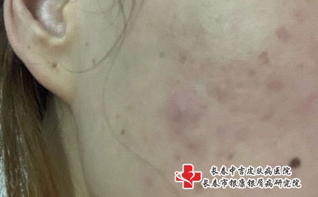 痤疮的成因有哪些，长春治疗痤疮专业医院