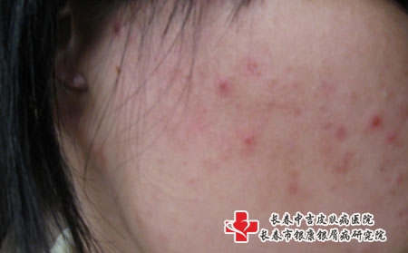 出现大量痤疮的原因是什么,长春专治痤疮的医院 出现大量痤疮的原因是什么,长春专治痤疮的医院