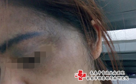 青胎记的病因，长春治疗青胎记医院哪家比较好