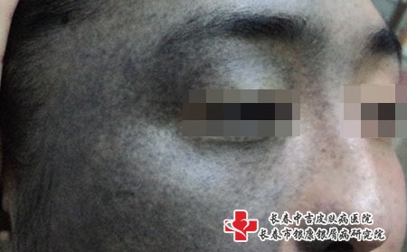 青胎记对身体危害吗，长春胎记医院治疗青胎记专业吗