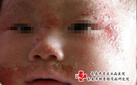 湿疹怎么预防，长春中吉医院看湿疹