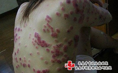 银屑病的常见原因是什么,长春牛皮癣医院医治银屑病多少费用 银屑病的常见原因是什么,长春牛皮癣医院医治银屑病多少费用
